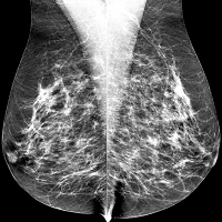 Radiologie Norderstedt Digitale Niedrigdosis Mammographie Low Dose